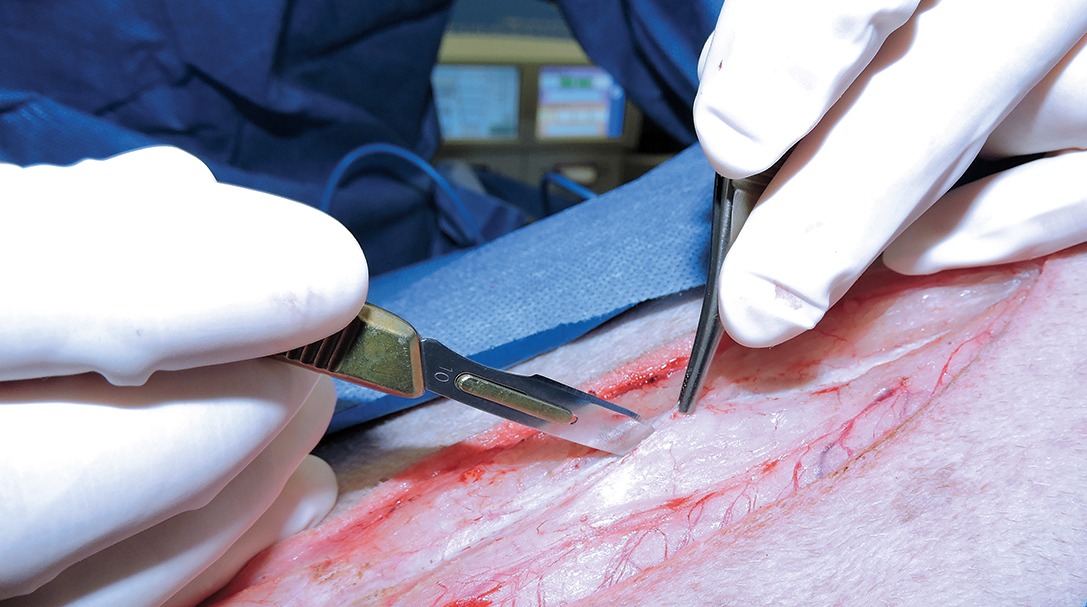Incision and drainage